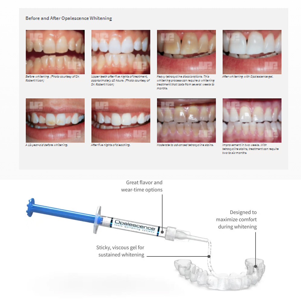 Opalescence Whitening 20% PF 2 – Teeth Whitening With Peroxide recenzja i cena