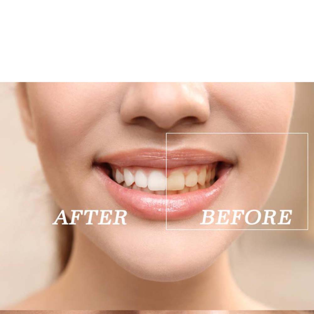 Najwyższej jakości zestaw żelo – Teeth Whitening With Peroxide recenzja i cena