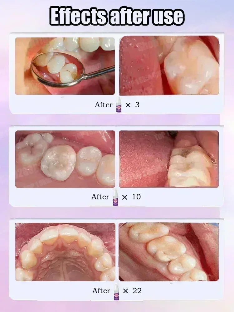 Gorąca sprzedaż Najlepiej sprz – Teeth Whitening Best recenzja i cena
